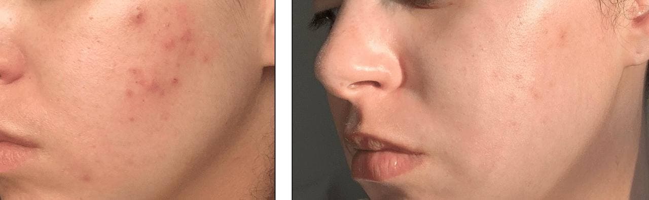 Acne correction — staged protocol result
