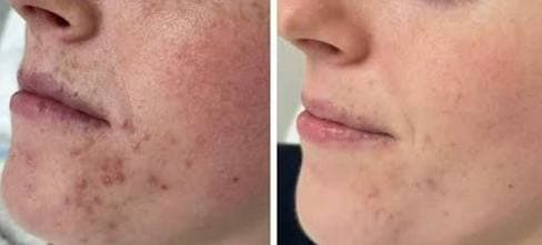 BioRePeel — clinical result