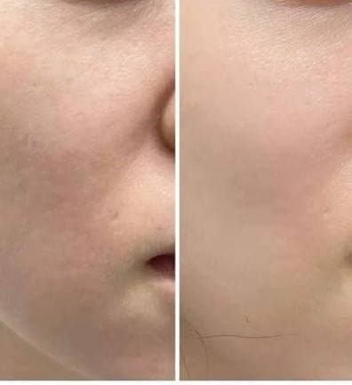 Scalp Microneedling — clinical result