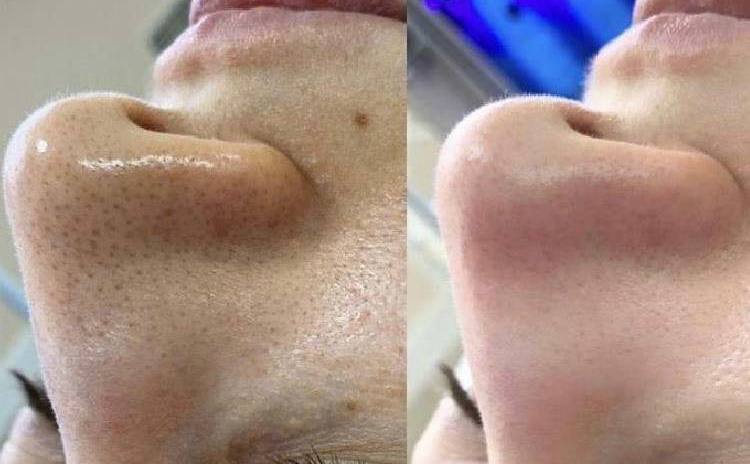 Limpieza facial profunda combinada