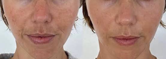 Microneedling con PDRN (ADN de salmón)